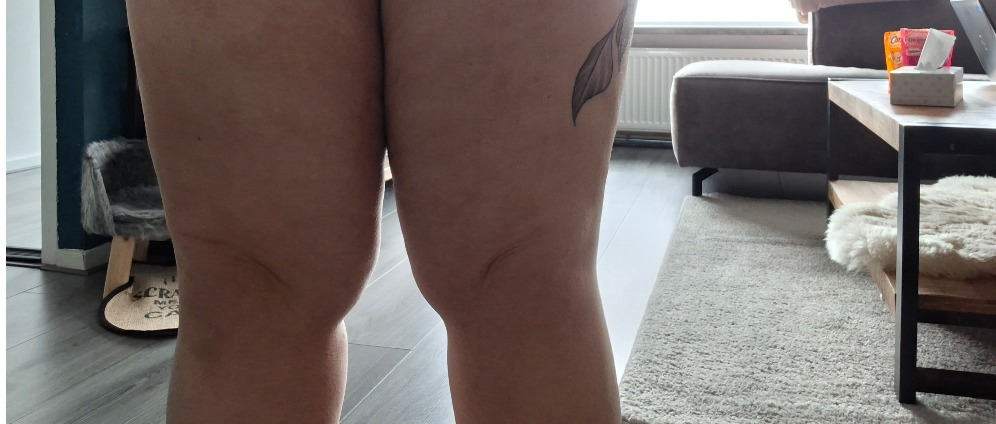 Geld inzamelen | Ik heb lipoedeem het word niet vergoed.. help mij | Doneeractie