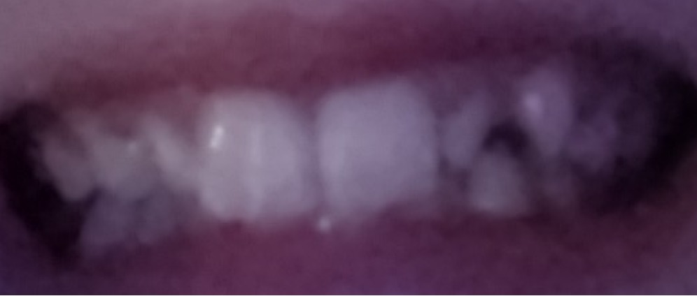 Geld inzamelen | Beugel nodig maar niet genoeg geld. | Doneeractie