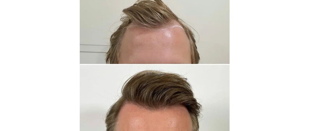Geld inzamelen | Turkish Hairline for Alex | Doneeractie