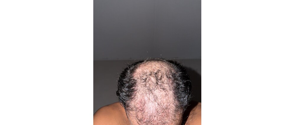 Geld inzamelen | Haartransplantatie | Doneeractie
