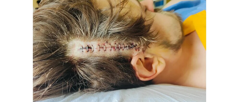 Revalidatie schedelbasisfractuur | Geld inzamelen