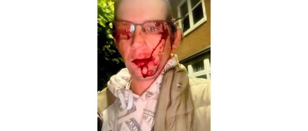 Geld inzamelen | Slachtoffer zinloos geweld mishandeling met ernstig letsel | Doneeractie