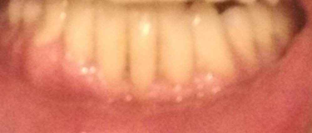 Geld inzamelen | Tandvleestransplantatie gebit | Doneeractie